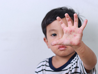 Hand Foot and Mouth Disease